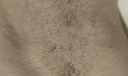 Лазерная эпиляция Мастер депиляции Виктория Харьков