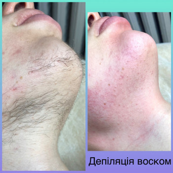 Чоловіча депіляція