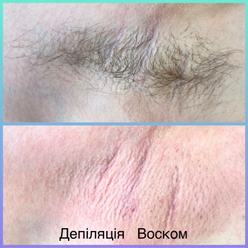 Депіляція пахв воском