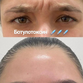 Ботулотоксін міжбрів'я Тривалість процедури 20 хв Ціна 1300 гр