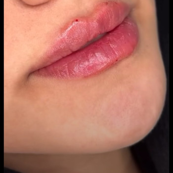 1 ml Rewolax deep