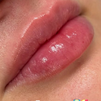 Yltra kiss 1 ml