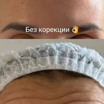 Ботулінотерапія чола