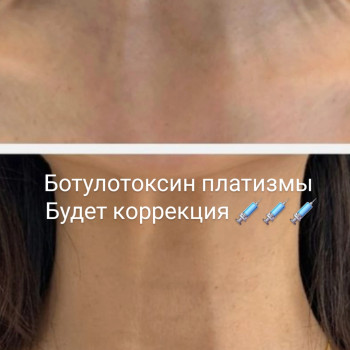 Ботулінотерапія платизми