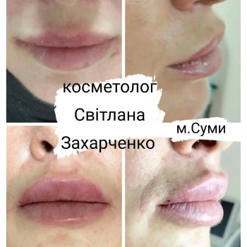 Корекція губ