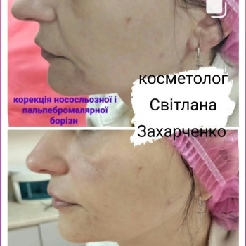 корекція середньої третини обличчя