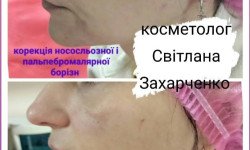 Контурна пластика філерами на основі гіалуронової кислоти Косметолог-инъекционист Светлана Сумы