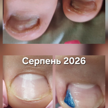 Відновлення нігтів