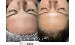 Карбокситерапия GIGI Carboxy + пилинг Косметолог Наталья Одесса