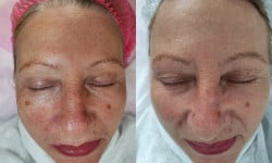 IPL фото терапія Косметолог Ирина Черкаси