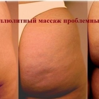Антицеллюлитный ручной массаж
                    Масажист Александр Белоус Миколаїв