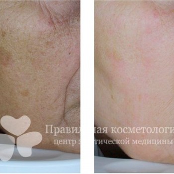 аппаратная косметология лица, коррекция морщин, косметология лица