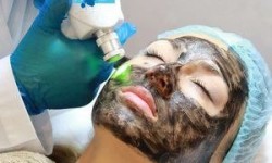 Карбоновый пилинг: лицо Центр аппаратной косметологии New Skin Одеса