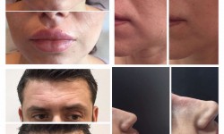 Контурная пластика Косметолог Светлана Колесник Киев