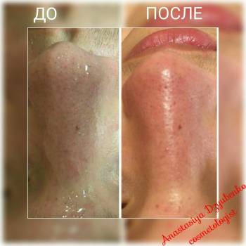 Механическая чистка лица подросток