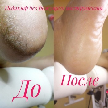 Аппаратный педикюр с элементами медицинского
                    Нігтьова студія Подо студия номер 1 Наталии Ушецкой Одеса