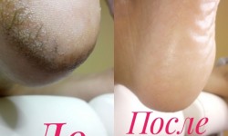 Аппаратный педикюр с элементами медицинского Нігтьова студія Подо студия номер 1 Наталии Ушецкой Одеса