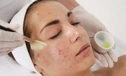 Пилинг для проблемной кожи «MaskPeel» Салон красоты Persik Днепр