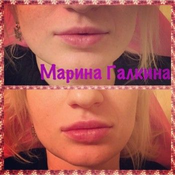 Увеличение губ филлерами (гиалуроновая кислота)
                    Косметолог Марина Галкина Київ