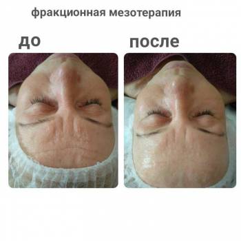 дермаштамп (дермапен, фракционная мезотерапия