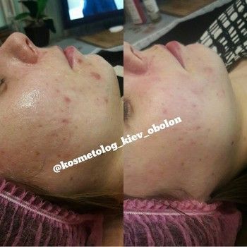 Химический салициловый пилинг для жирной кожи
                    Косметолог Алина Батлер Киев