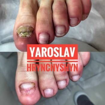 вросший ноготь, грибок ногтя, лечение стопы