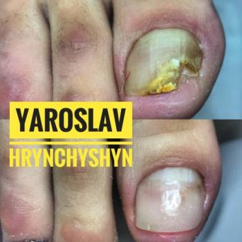 грибок ногтя, лечение ногтей на ногах