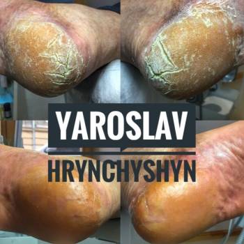 подология, чистка пятки, лечение стопы