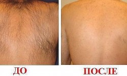 Депиляция воском спины Косметолог-инъекционист Наталия Одесса