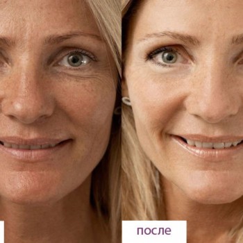 Биорепарация Aquahine
                    Косметолог-инъекционист Наталия Одесса