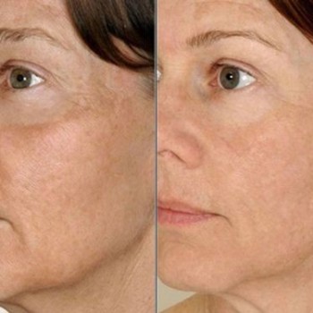 Биорепарация Aquahine
                    Косметолог-инъекционист Наталия Одесса