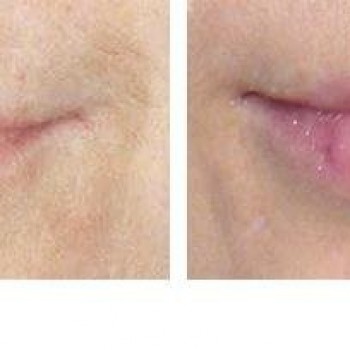 Увеличение губ
                    Косметолог-ін'єкціоніст Наталия Одеса