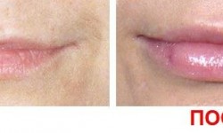 Увеличение губ Косметолог-инъекционист Наталия Черновцы