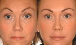 Ботокс Ботулинотерапия Botox Косметолог-инъекционист Наталия Черновцы