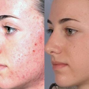 Пилинг Джесснера
                    Косметолог-инъекционист Наталия Одесса