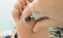 Подология: Удаление корня мозоля на коже (без педикюра) Салон красоты Сан-Тропе+ Киев
