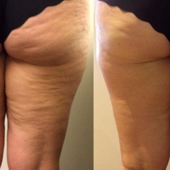 Классическая процедура LPG массажа против лишнего веса и целлюлита
                    Медичний центр Slim Medical Київ