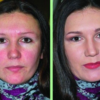Энзимный пилинг
                    Косметологическая клиника Делекос Київ