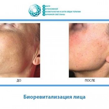 уход за лицом, коррекция морщин, косметология лица