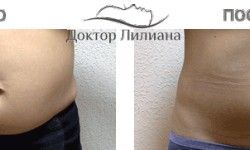Прессотерапия Медицинский центр Доктор Лилиана Одесса