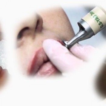 Удаление татуажа бровей
                    Медичний центр Estetic Medical Одеса