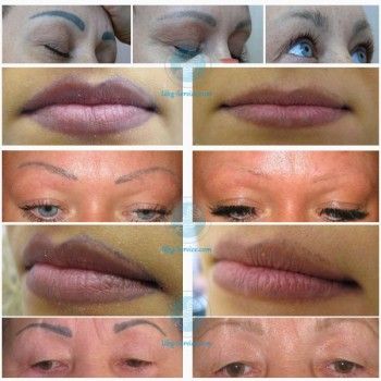 Удаление татуажа бровей
                    Медичний центр Estetic Medical Одеса