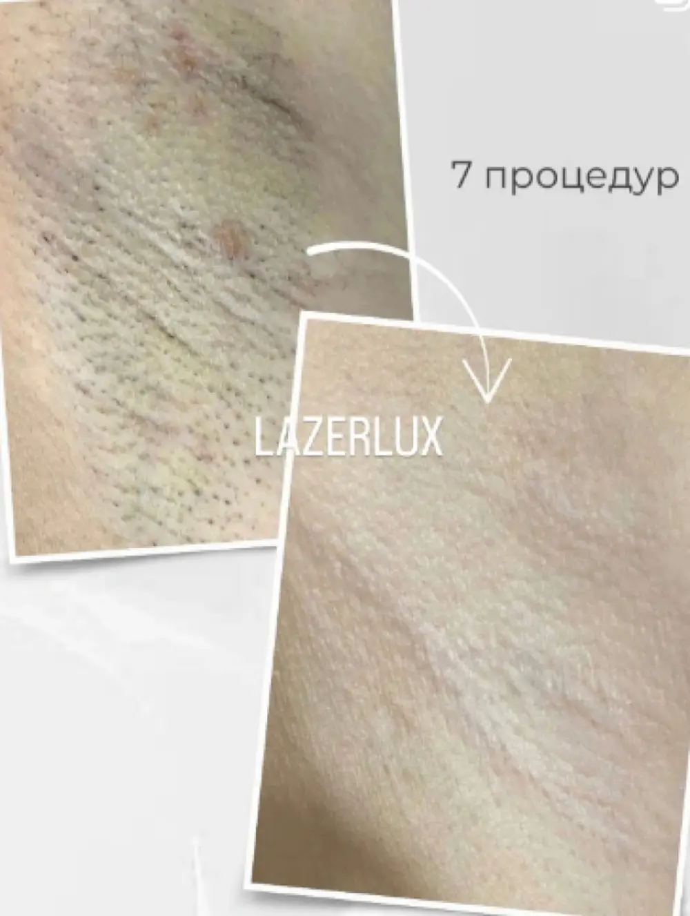 Лазерная эпиляция подмышек, фото до и после