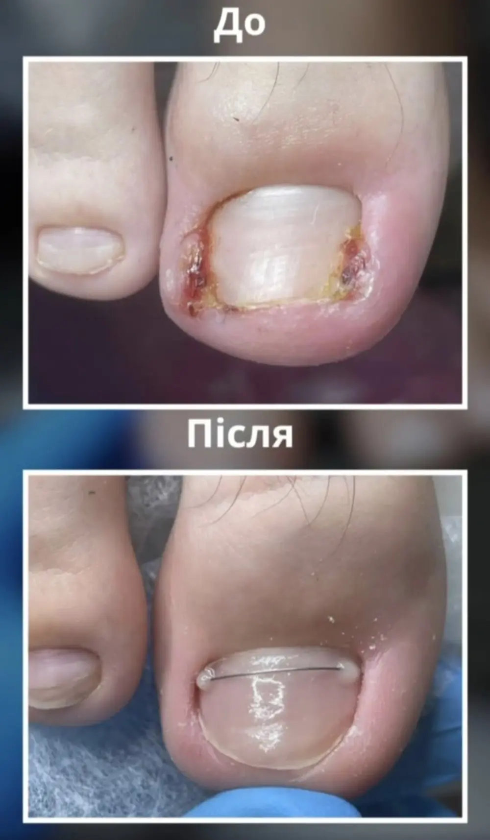 Лечение вросшего ногтя, фото до и после