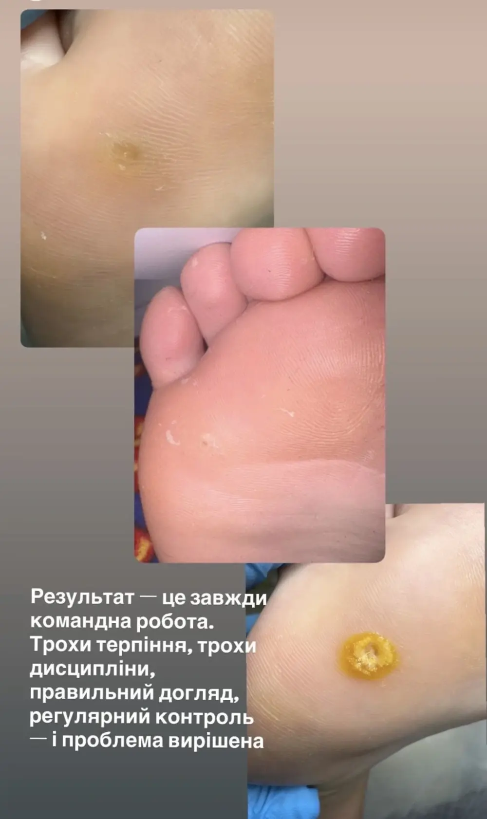 Удаление мозолей, фото до и после