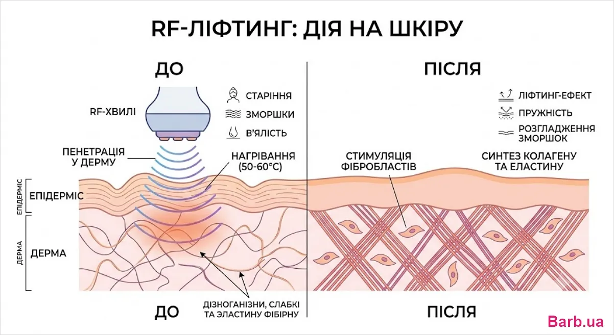 Я працює rf ліфтинг