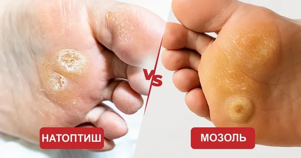 Фото: Разница между стержневой мозолью и натоптышем
