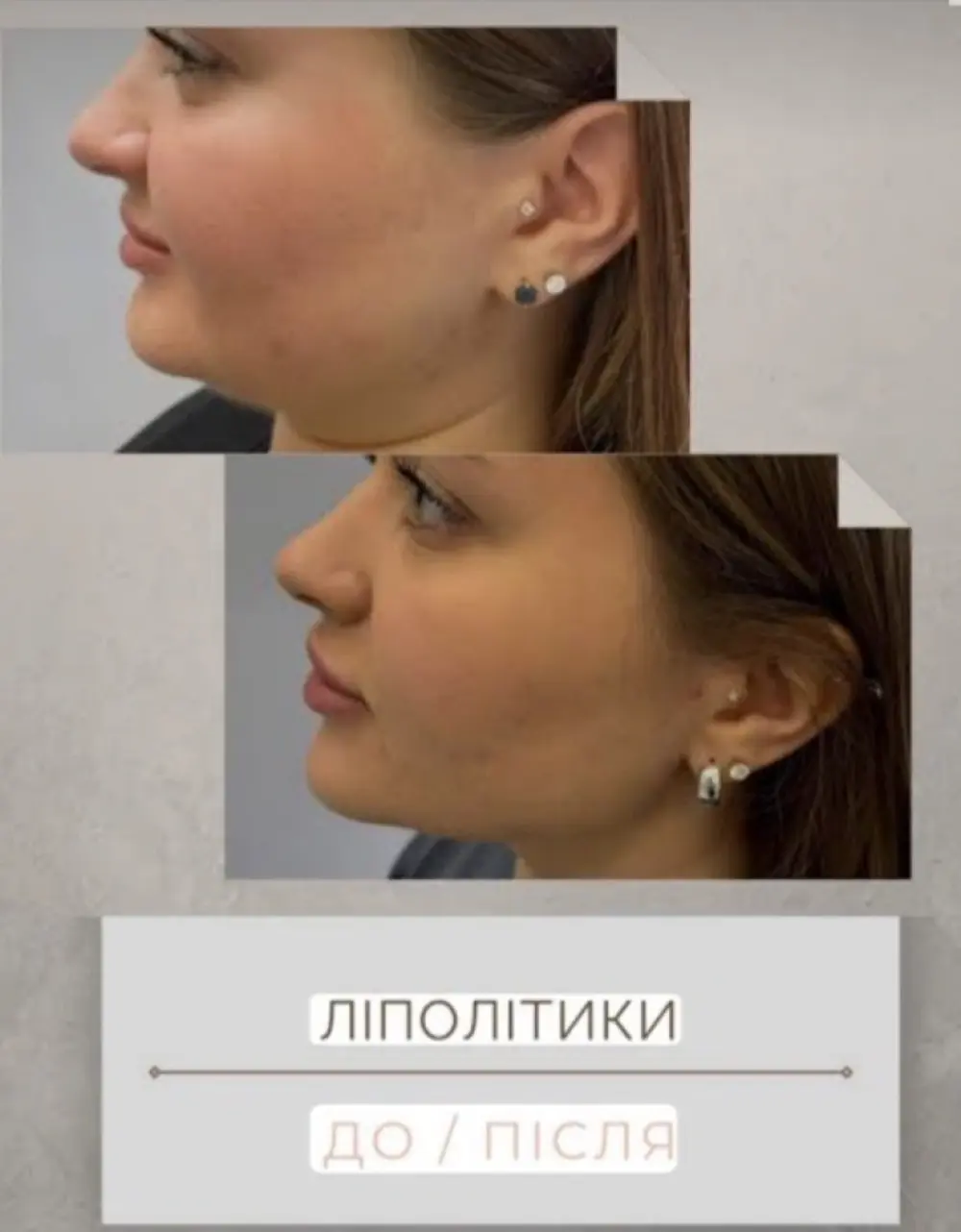 Уколы липолитиков